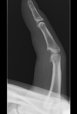 Finger Volar Plate Arthroplasty